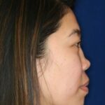 Permanent non-surgical rhinoplasty - Right Profile - Before Pic - Permanent filler - Pre-injury appearance restored - Top Rhinoplasty Surgeon