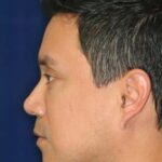Permanent Non-surgical Rhinoplasty - Left Profile - After Pic - Permanent filler - Obscuring hump - Tip refinement - Best Nose Job Surgeon