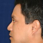 Permanent Non-surgical Rhinoplasty - Left Profile - Before Pic - Permanent filler - Obscuring hump - Tip refinement - Nose Job in Beverly Hills