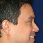 Permanent Non-surgical Rhinoplasty - Right Profile - After Pic - Permanent filler - Obscuring hump - Tip refinement - Beverly Hills Rhinoplasty Superspecialist