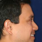 Permanent Non-surgical Rhinoplasty - Right Profile - Before Pic - Permanent filler - Obscuring hump - Tip refinement - Top Rhinoplasty Surgeon
