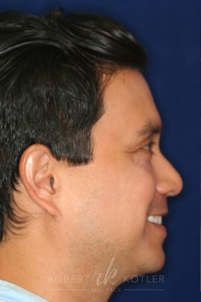 Permanent Non-surgical Rhinoplasty - Right Profile - Before Pic - Permanent filler - Obscuring hump - Tip refinement - Top Rhinoplasty Surgeon