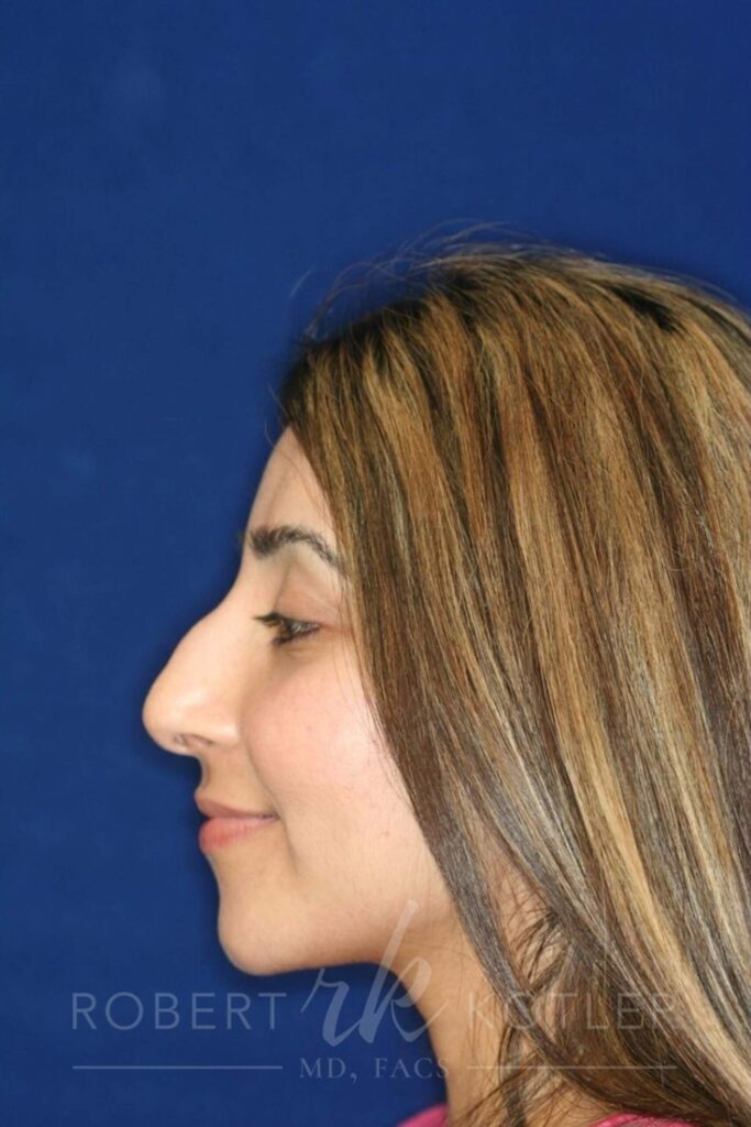Closed Rhinoplasty - Bump removal - refined tip - slight elevation from lip - Left Profile - Before Pic - Top Rhinoplasty Surgeon