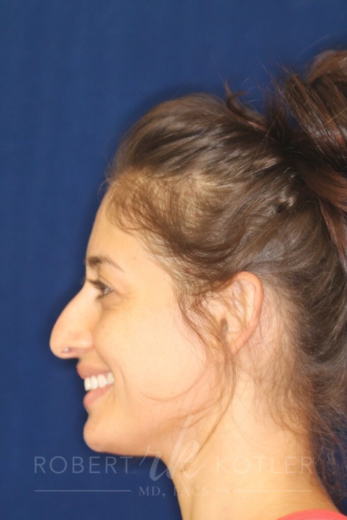 Closed Rhinoplasty - Lowering of the bridge and refine the tip - Left Profile Smile - Before Pic - Nose Job in Beverly Hills