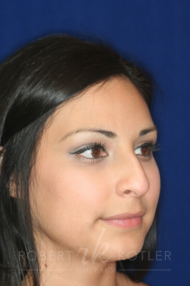Closed Rhinoplasty - Right Profile - Before Pic - Hump removal - Lowered profile - Tip enhancement - Nose elevated from lip - Best Rhinoplasty Beverly Hills
