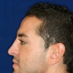 Closed Rhinoplasty - Left Profile - After Pic - Tip refinement - Nose recessed closer to face - Lowering of bridge - Top Rhinoplasty Surgeon