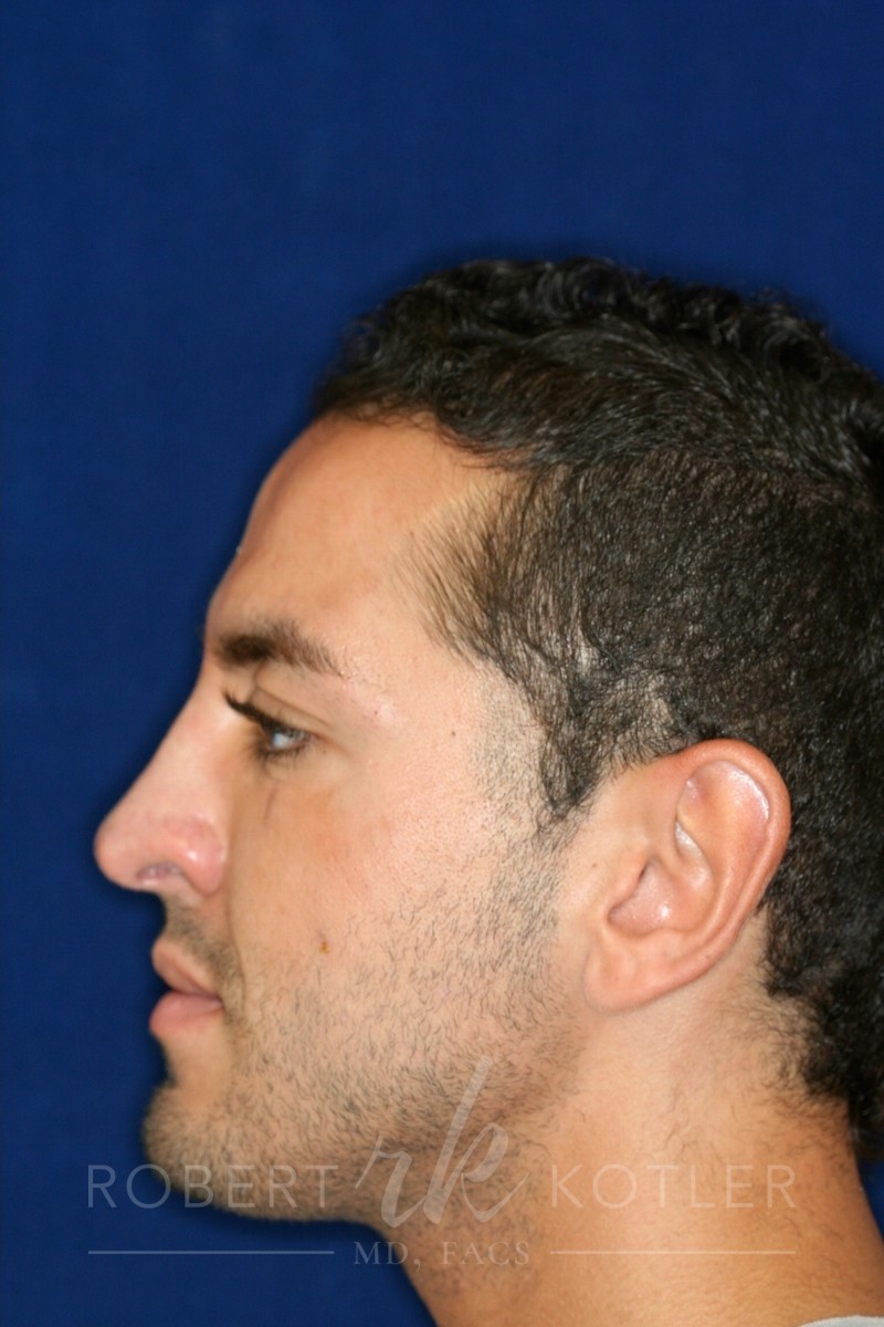 Closed Rhinoplasty - Left Profile - After Pic - Tip refinement - Nose recessed closer to face - Lowering of bridge - Top Rhinoplasty Surgeon