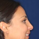 Closed Rhinoplasty - Right Profile - Smile - After Pic - Hump removal - Lowered profile - Tip enhancement - Nose elevated from lip - Beverly Hills Rhinoplasty Superspecialist