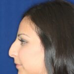 Closed Rhinoplasty - Left Profile - Before Pic - Hump removal - Lowered profile - Tip enhancement - Nose elevated from lip - Nose Job in Beverly Hills