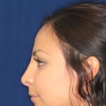 Closed Rhinoplasty - Left Profile - After Pic - Hump removal - Lowered profile - Tip enhancement - Nose elevated from lip - Best Nose Job Surgeon