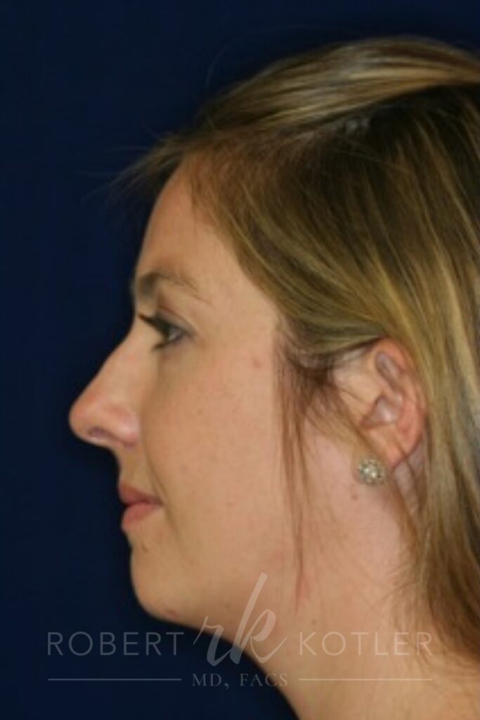 Closed Rhinoplasty - Left Profile - Before Pic - Broken nose correction - bump removal - nose tip refinement - nose elevated from lip - Rhinoplasty Surgeon in Beverly Hills
