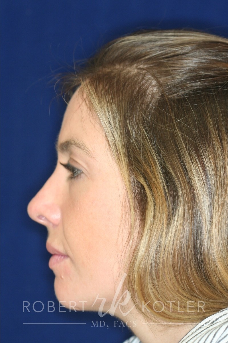 Closed Rhinoplasty - Left Profile - After Pic - Broken nose correction - bump removal - nose tip refinement - nose elevated from lip - Nose Job in Beverly Hills