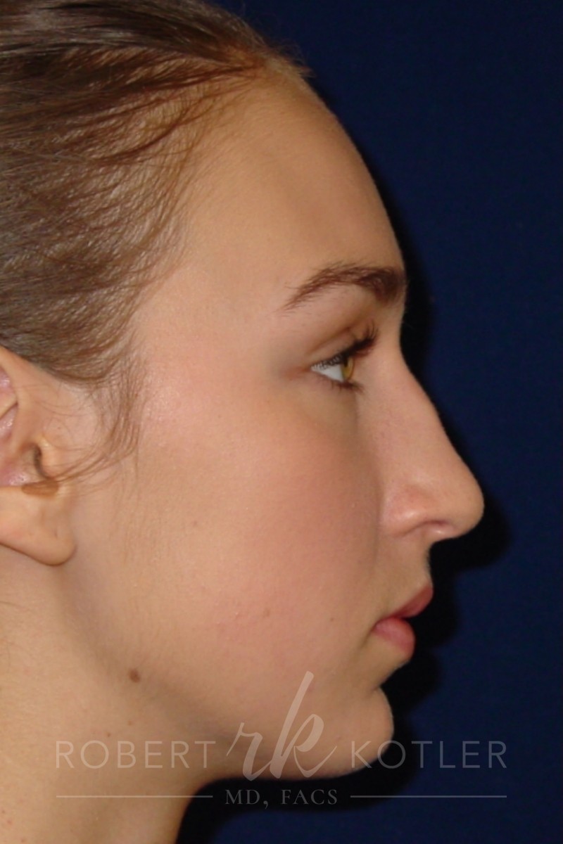 Closed Rhinoplasty - Right Profile - Before Pic - Nose tip refinement - Hump removal - Beverly Hills Rhinoplasty Superspecialist