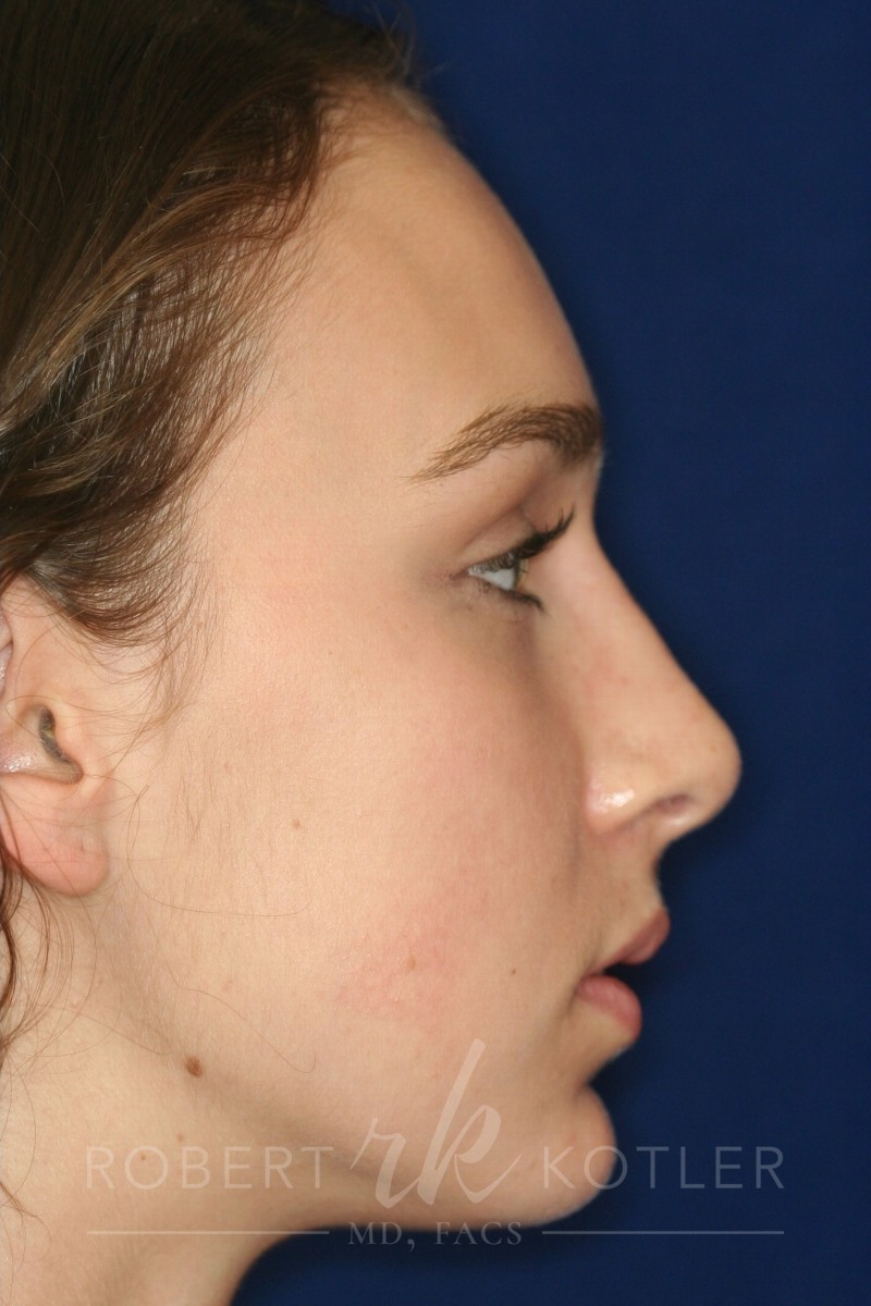 Closed Rhinoplasty - Right Profile - After Pic - Nose tip refinement - Hump removal - Best Rhinoplasty Beverly Hills