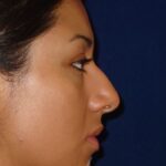 Closed Rhinoplasty - Right Profile - Before Pic - Hump removal - Tip refinement - Nose elevated from lip - Beverly Hills Rhinoplasty Superspecialist