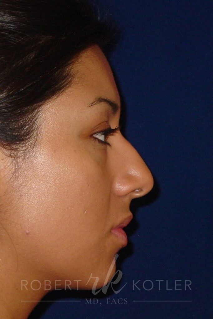 Closed Rhinoplasty - Right Profile - Before Pic - Hump removal - Tip refinement - Nose elevated from lip - Beverly Hills Rhinoplasty Superspecialist