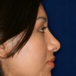 Closed Rhinoplasty - Right Profile - After Pic - Hump removal - Tip refinement - Nose elevated from lip - Best Rhinoplasty Beverly Hills