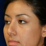 Closed Rhinoplasty - Left Angle Profile - Before Pic - Hump removal - Tip refinement - Nose elevated from lip - Rhinoplasty Surgeon in Beverly Hills