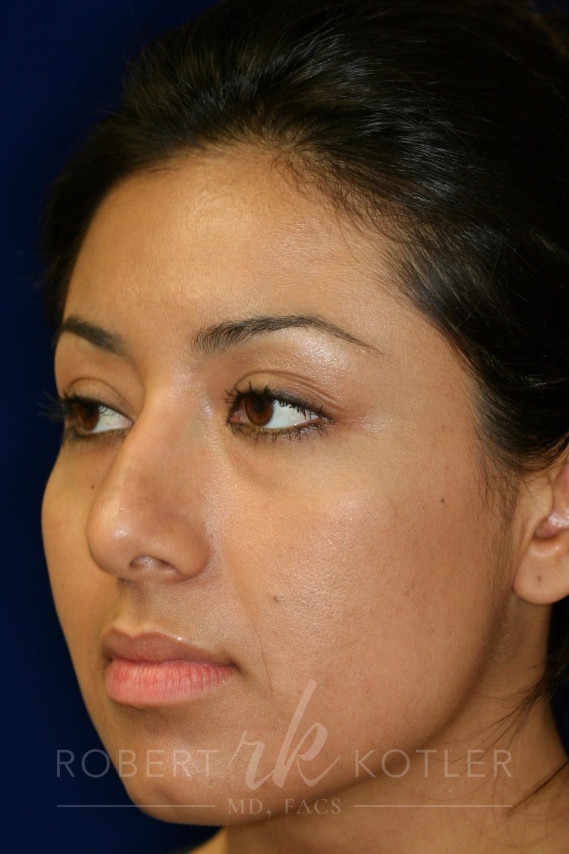 Closed Rhinoplasty - Left Angle Profile - Before Pic - Hump removal - Tip refinement - Nose elevated from lip - Rhinoplasty Surgeon in Beverly Hills