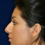 Closed Rhinoplasty - Left Profile - Before Pic - Hump removal - Tip refinement - Nose elevated from lip - Best Nose Job Surgeon