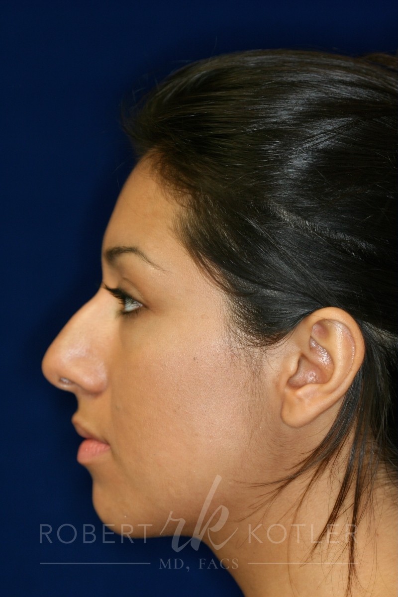 Closed Rhinoplasty - Left Profile - Before Pic - Hump removal - Tip refinement - Nose elevated from lip - Best Nose Job Surgeon