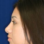 Alt: Closed Rhinoplasty - Left Profile - After Pic - Hump removal - Tip refinement - Nose elevated from lip - Best Nose Job Surgeon