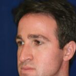Closed Rhinoplasty - Left Angle Shot - Before Pic - Hump Removal - Nose elevated from lip - Rhinoplasty Surgeon in Beverly Hills
