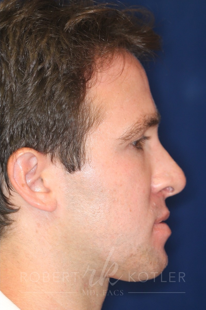 Closed Rhinoplasty - Right Profile - After Pic - Hump Removal - Nose elevated from lip - Rhinoplasty Surgeon in Beverly Hills