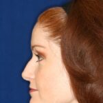 Closed Rhinoplasty - Lowering the profile, refining the nose tip- Left Profile - Before Pic -Best Rhinoplasty Beverly Hills