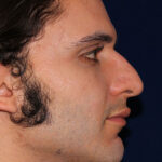 Rhinoplasty -Right Profile - Before Pic - Hump removal, tip refinement - Downward nose tip correction - Nose Job in Beverly Hills