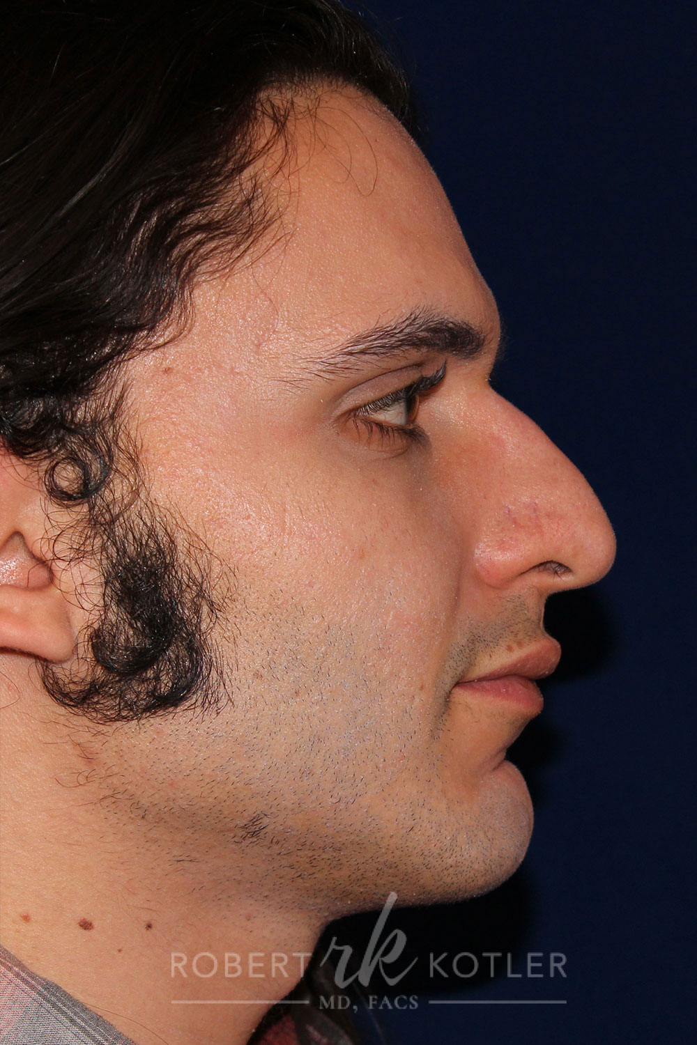 Rhinoplasty -Right Profile - Before Pic - Hump removal, tip refinement - Downward nose tip correction - Nose Job in Beverly Hills