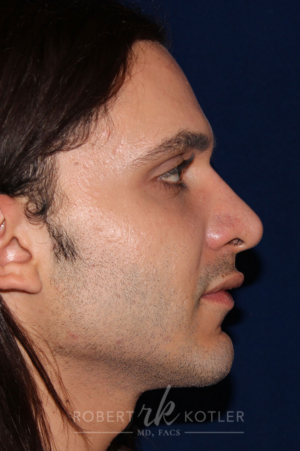 Rhinoplasty -Right Profile - After Pic - Hump removal with tip refinement and elevation - Downward nose tip correction - Best Nose Job Surgeon