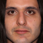 Rhinoplasty - Front Face View - Before Pic - Hump removal, tip refinement - Downward nose tip correction - Top Rhinoplasty Surgeon
