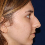 Rhinoplasty - Right Profile - Before Pic - Hump removal - Nose tip refinement - Chin augmentation - Best Rhinoplasty Beverly Hills