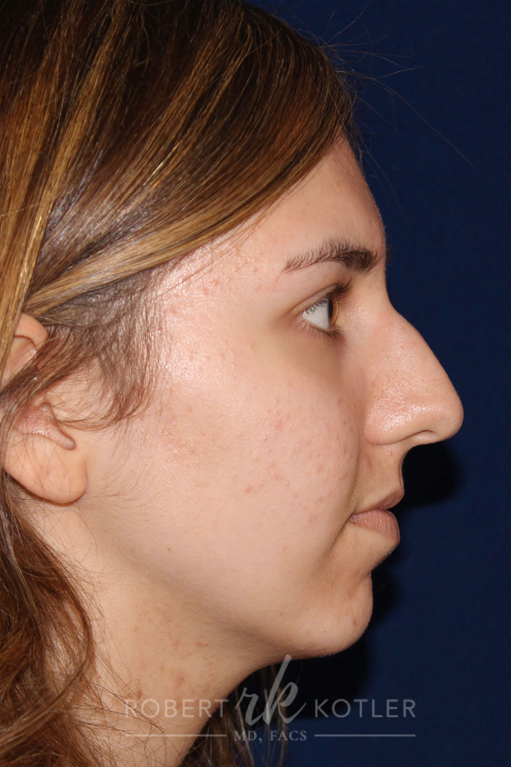 Rhinoplasty - Right Profile - Before Pic - Hump removal - Nose tip refinement - Chin augmentation - Best Rhinoplasty Beverly Hills