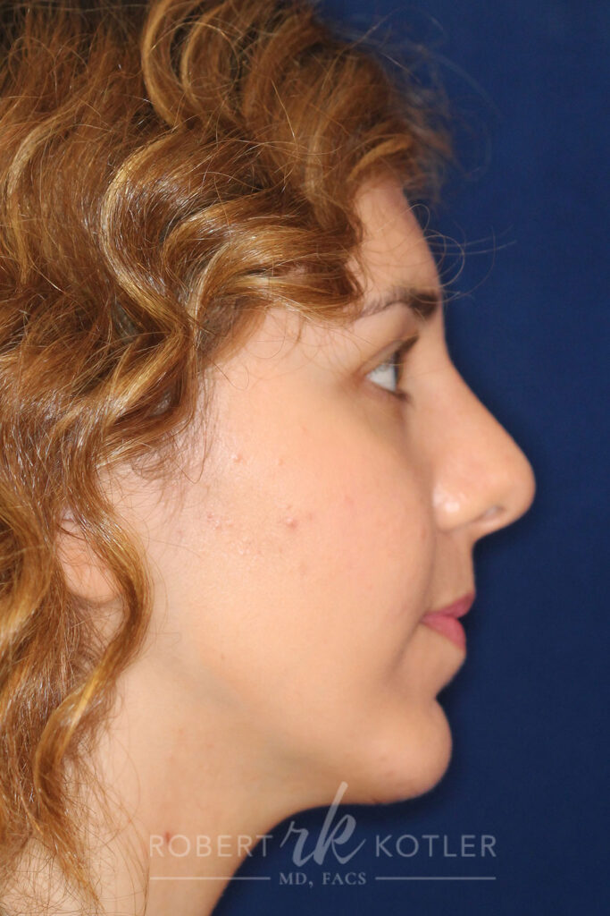 Rhinoplasty - Right Profile - After Pic - Hump removal - Nose tip refinement - Chin augmentation - Rhinoplasty Surgeon in Beverly Hills