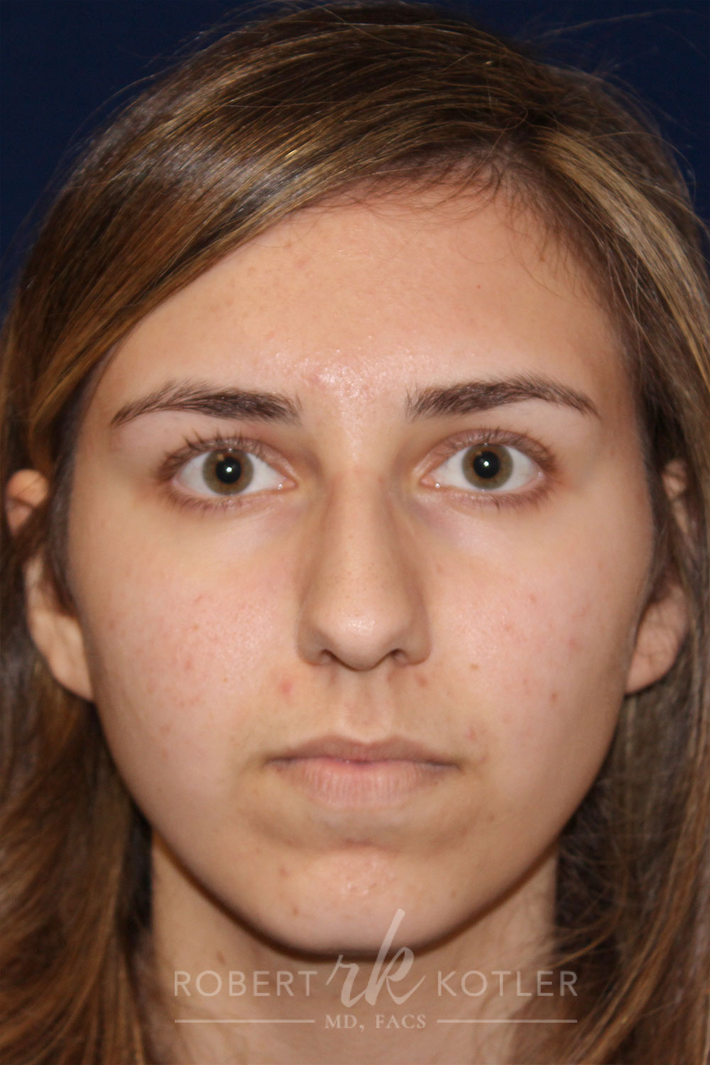 Rhinoplasty - Front Face View - Before Pic - Hump removal - slight tip elevation and refinement - Chin augmentation - Nose Job in Beverly Hills