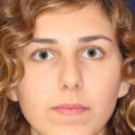Rhinoplasty - Front Face View -After Pic - Hump removal - slight tip elevation and refinement - Chin augmentation - Best Nose Job Surgeon