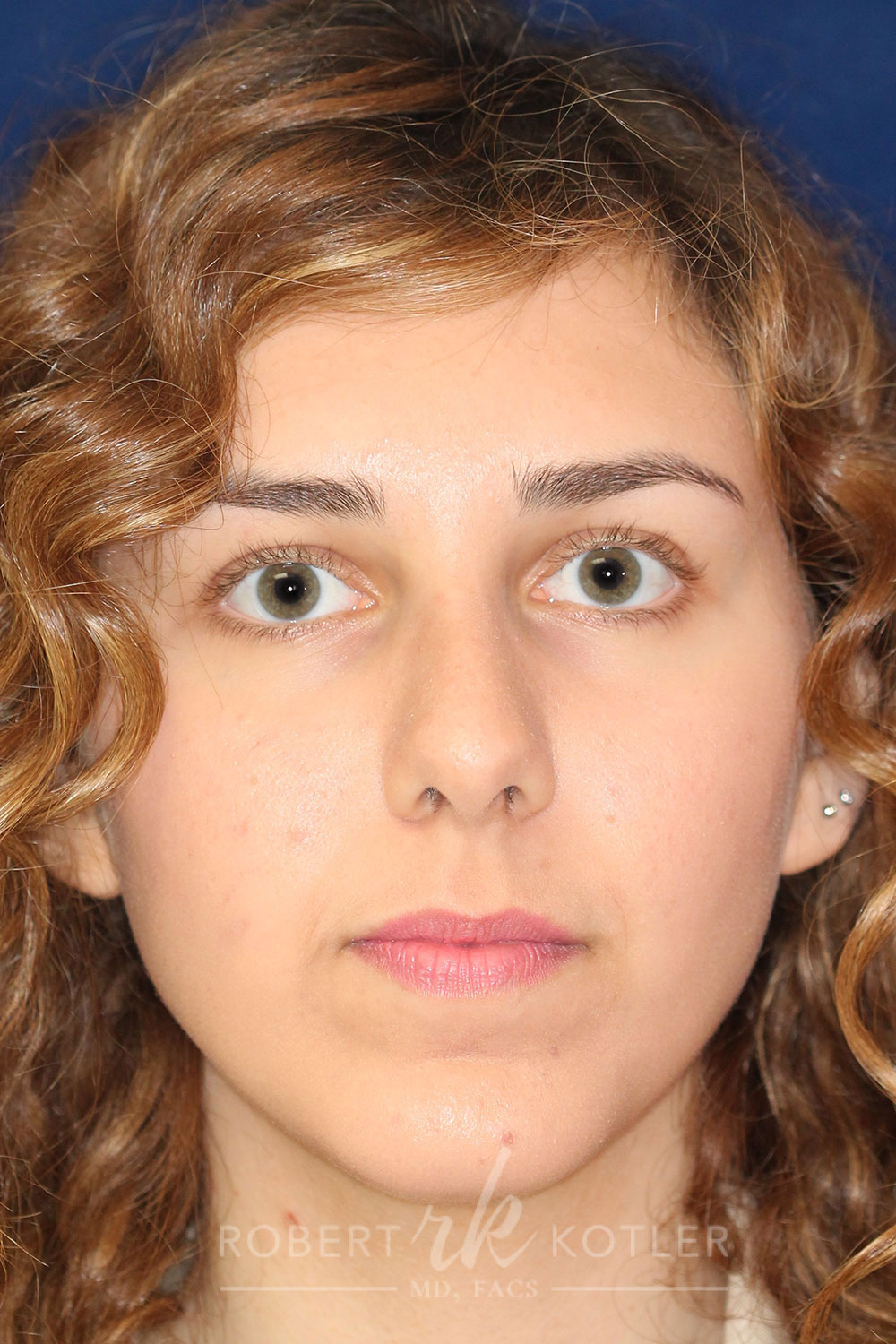 Rhinoplasty - Front Face View -After Pic - Hump removal - slight tip elevation and refinement - Chin augmentation - Best Nose Job Surgeon