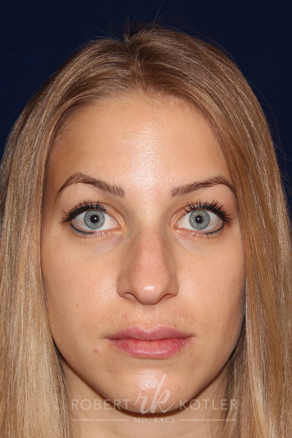 Rhinoplasty -Front Face View - Before Pic - Narrowing of the nose and bridge - Nose tip refinement - Tip elevation - Best Rhinoplasty Beverly Hills