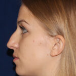 Rhinoplasty - Left Profile - Before Pic - Narrowing of the nose and bridge - Nose tip refinement - Tip elevation - Top Rhinoplasty Surgeon