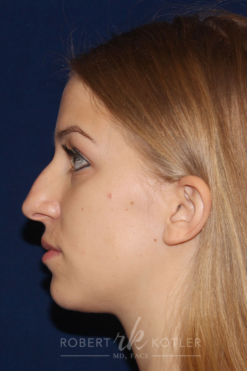 Rhinoplasty - Left Profile - Before Pic - Narrowing of the nose and bridge - Nose tip refinement - Tip elevation - Top Rhinoplasty Surgeon
