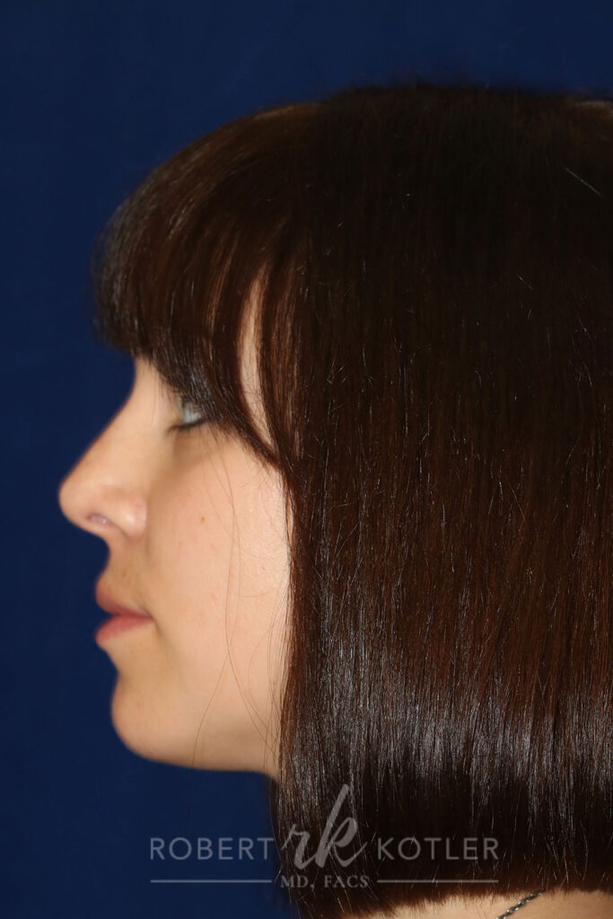 Rhinoplasty - Left Profile - After Pic - Narrowing of the nose and bridge - Nose tip refinement - Tip elevation - Beverly Hills Rhinoplasty Superspecialist