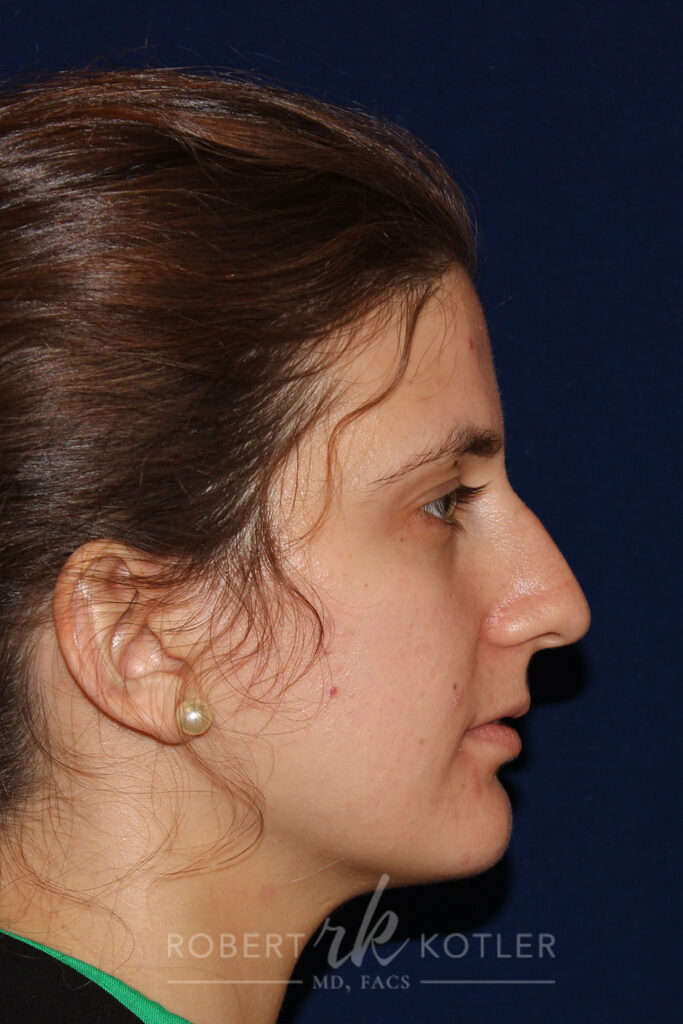 Closed Rhinoplasty - Right Profile - Before Pic - Hump removal - tip refinement - nose tip elevation - Beverly Hills Rhinoplasty Superspecialist
