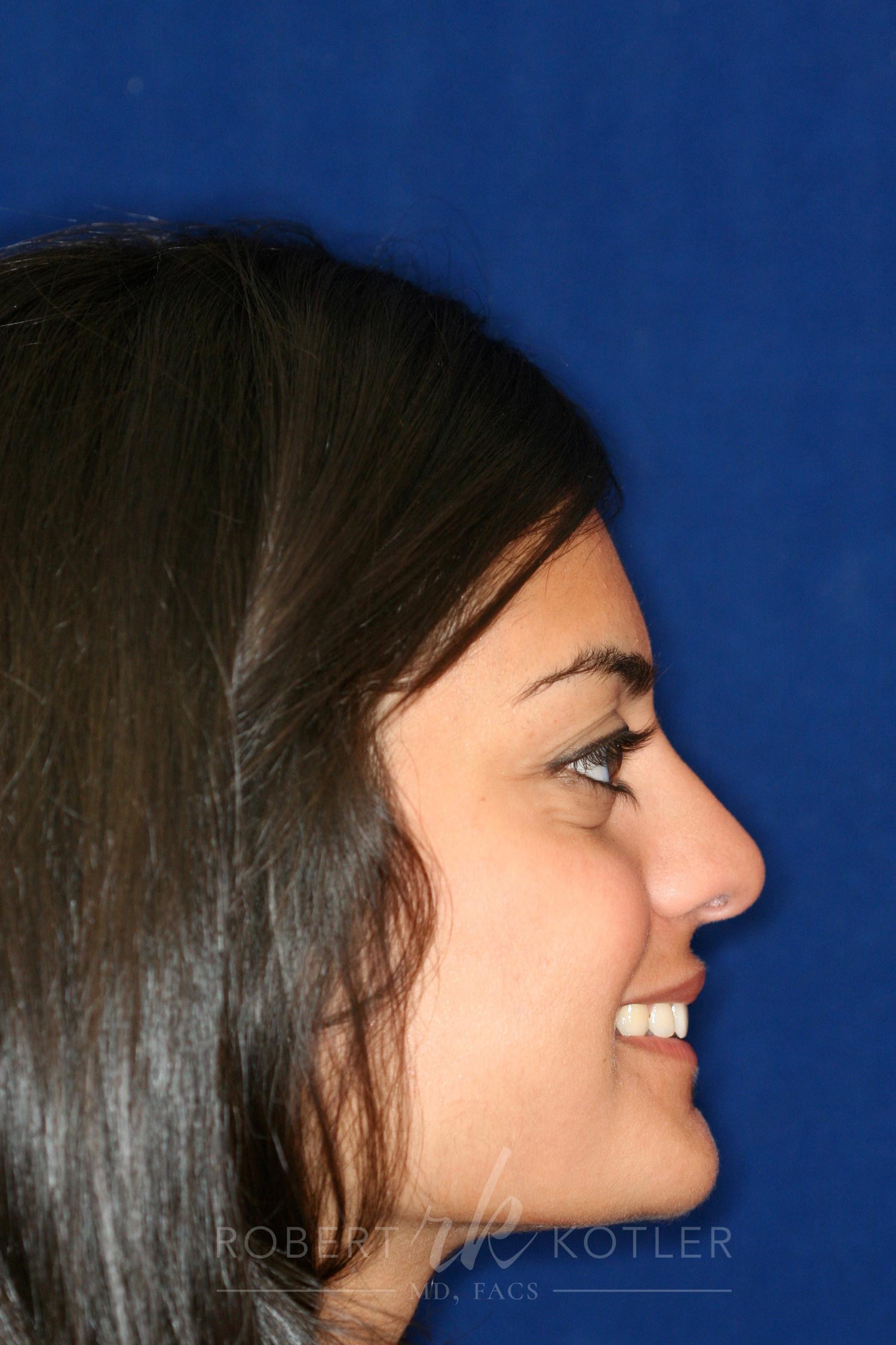 Rhinoplasty Before and After