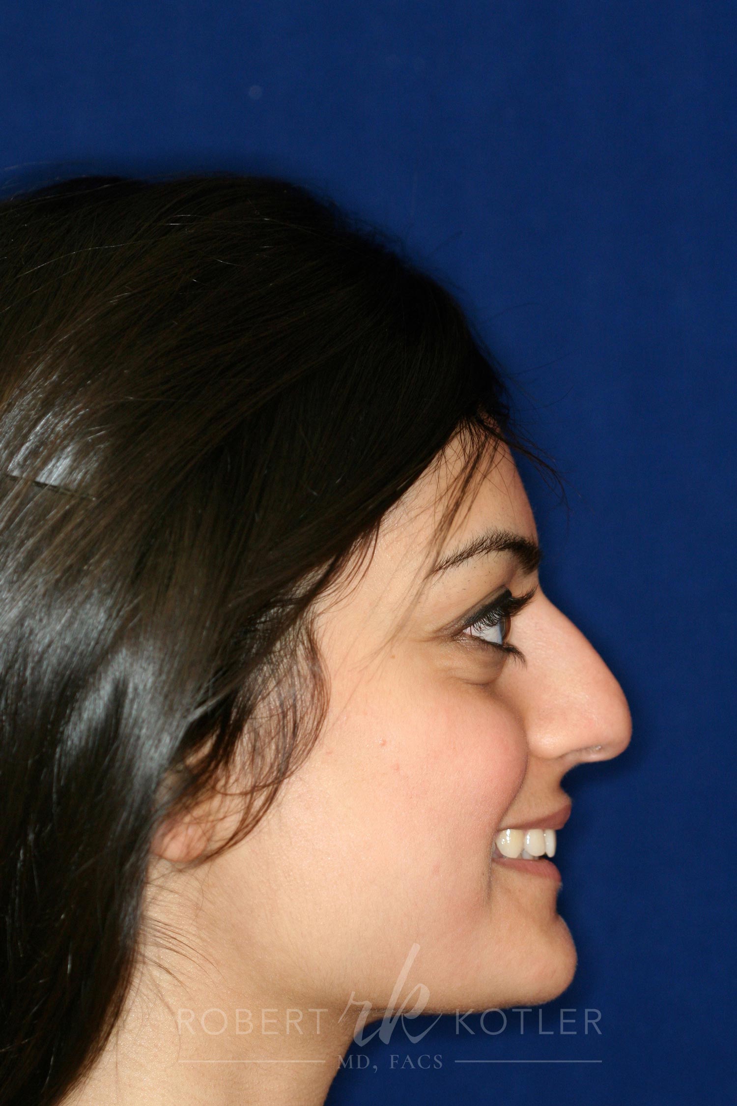 Rhinoplasty Before and After