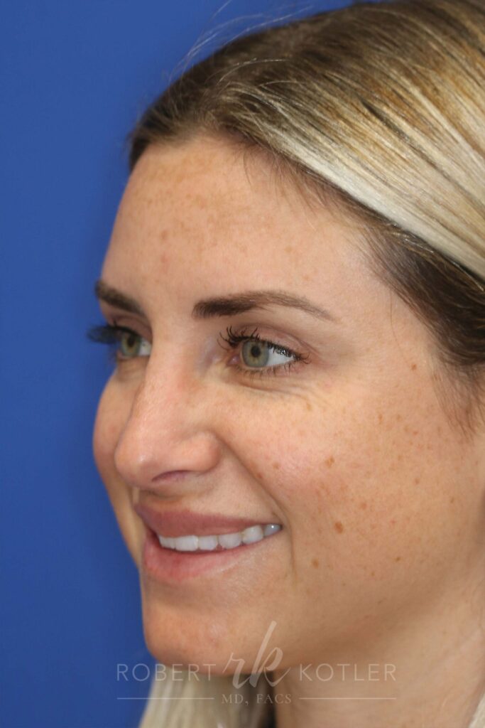 rhinoplasty-beverly-hills-ca-20295