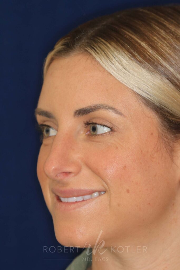 rhinoplasty-beverly-hills-ca-20296