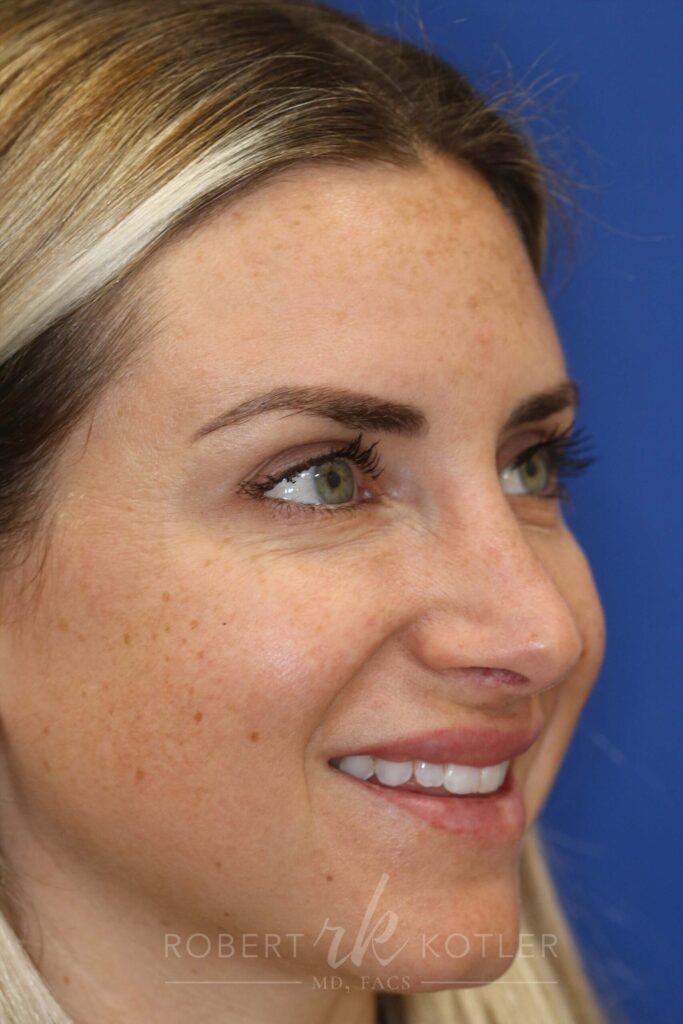 rhinoplasty-beverly-hills-ca-20297