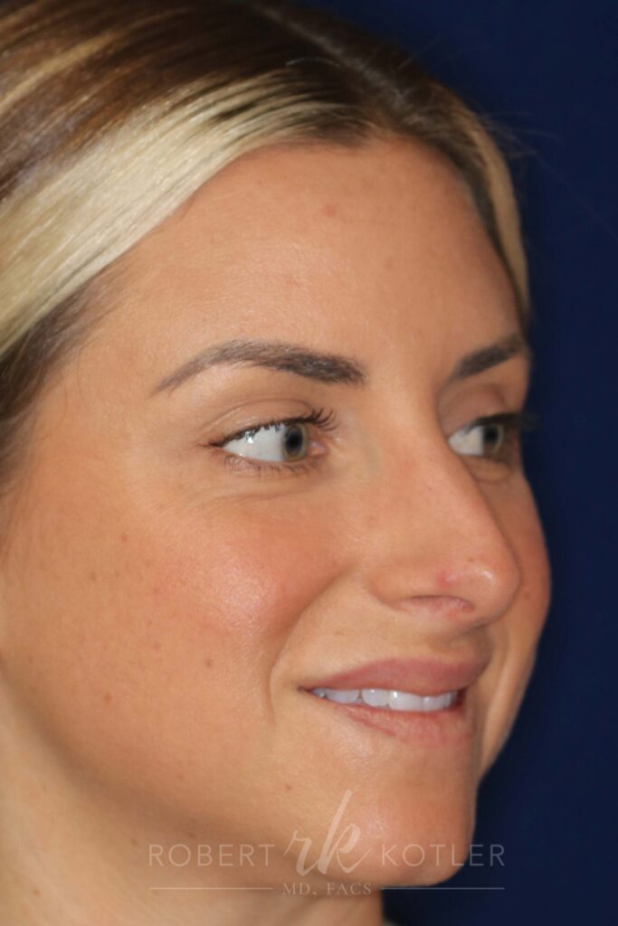 rhinoplasty-beverly-hills-ca-20298
